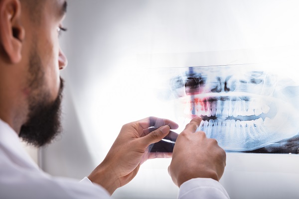 General Dentistry: Why Do I Need X Rays?