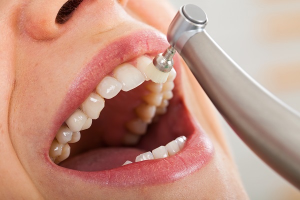 Benefits Of Professional Teeth Cleaning