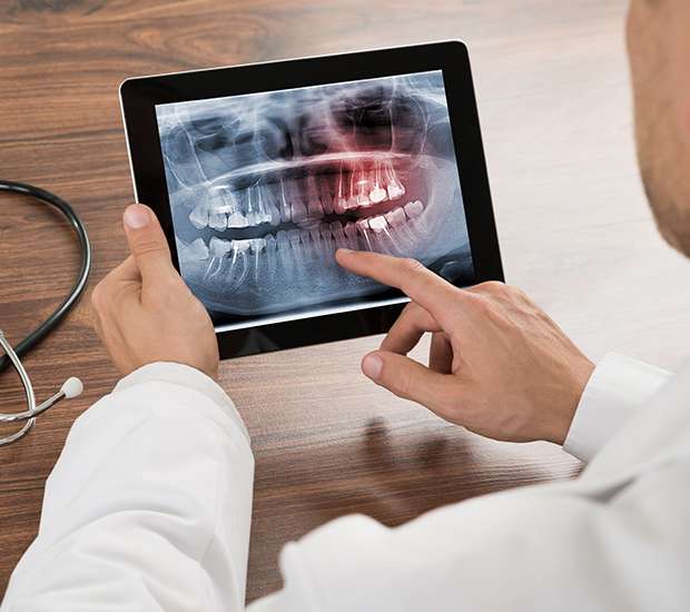 Tucson Types of Dental Root Fractures